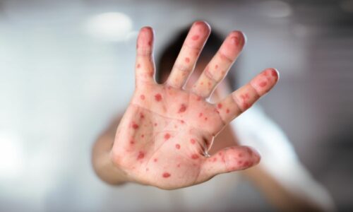measles, Manatee Bay Elementary, Florida Department of Health, Joseph Ladapo, Broward County Public Schools, Peter Licata