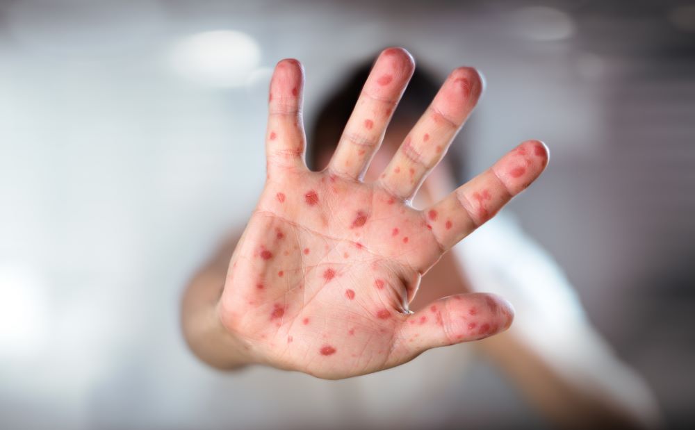 measles, Manatee Bay Elementary, Florida Department of Health, Joseph Ladapo, Broward County Public Schools, Peter Licata