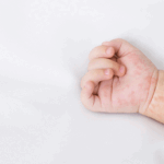 measles outbreaks