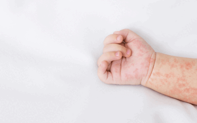 Measles Resurgence Looms: Experts Urge Immediate Vaccine Action