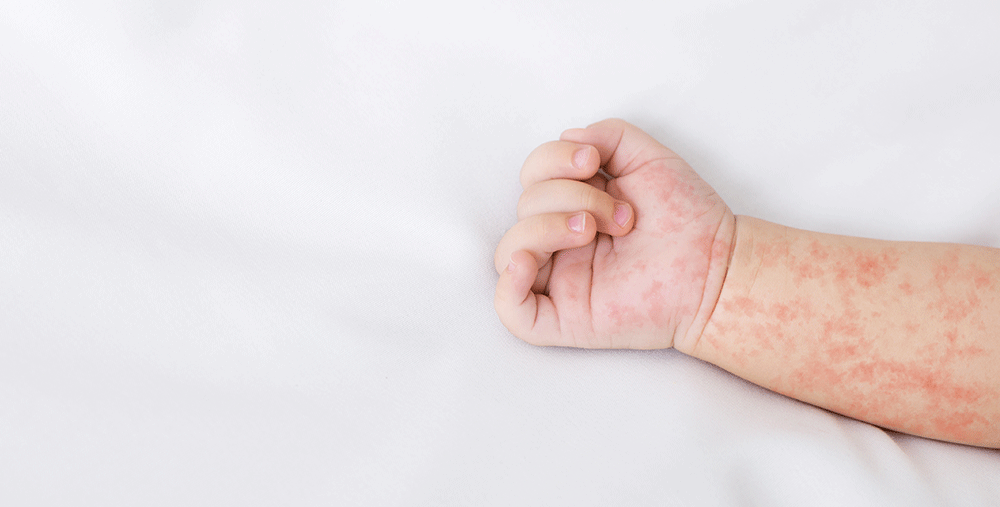 measles outbreaks