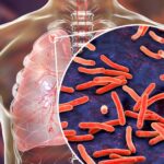 The tuberculosis outbreak at Archbishop Riordan High School has prompted a comprehensive restart of testing and infection control processes. San Francisco Department of Public Health, infectious diseases in schools, TB symptoms