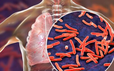 Third Tuberculosis Case Confirmed at Private California High School