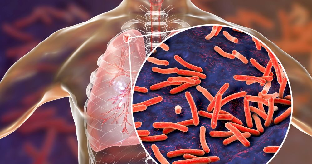 The tuberculosis outbreak at Archbishop Riordan High School has prompted a comprehensive restart of testing and infection control processes. San Francisco Department of Public Health, infectious diseases in schools, TB symptoms